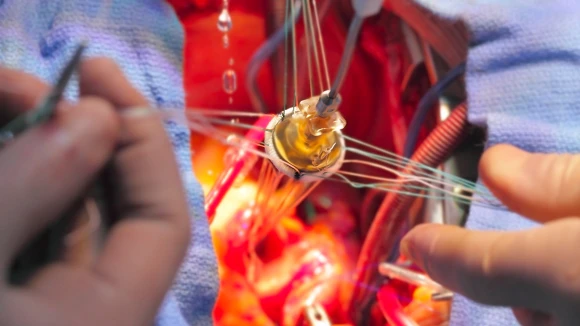 Bespoke Cardiac Valve